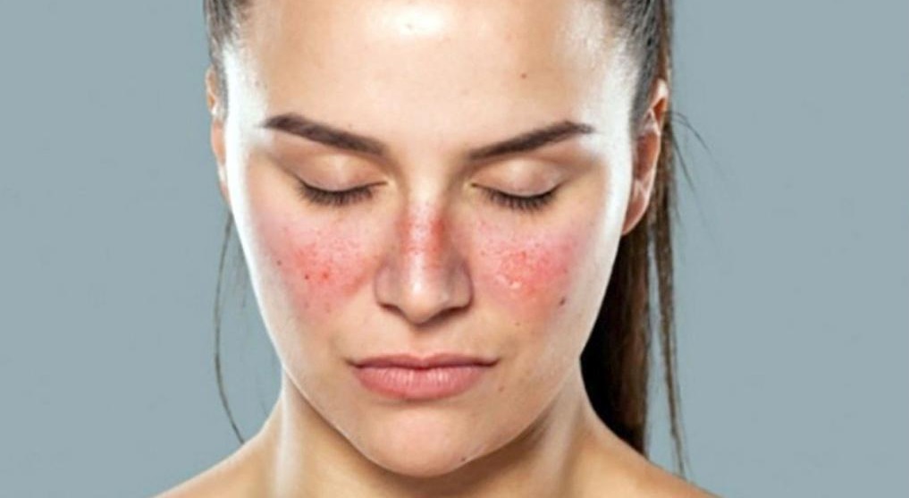 lupus