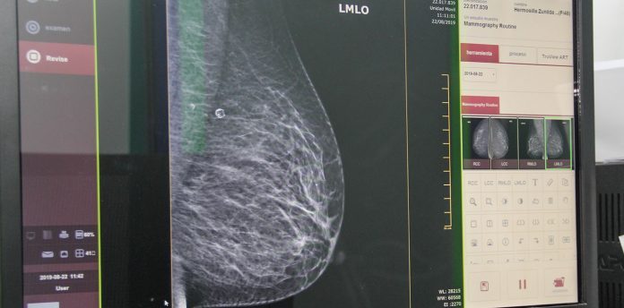 mamografia